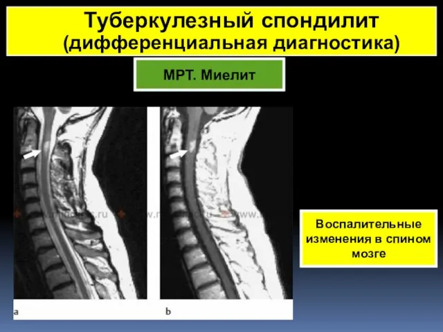 МРТ. Миелит Воспалительные изменения в спином мозге Туберкулезный спондилит (дифференциальная диагностика)