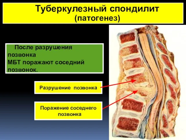 После разрушения позвонка МБТ поражают соседний позвонок. Разрушение позвонка Туберкулезный спондилит (патогенез) Поражение соседнего позвонка