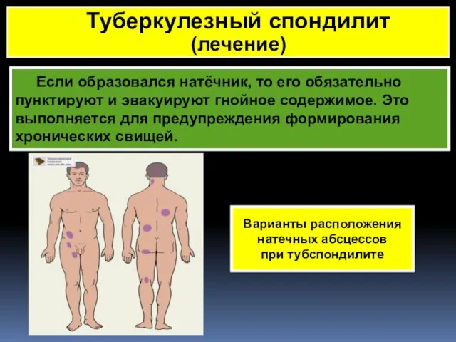 Если образовался натёчник, то его обязательно пунктируют и эвакуируют гнойное содержимое.