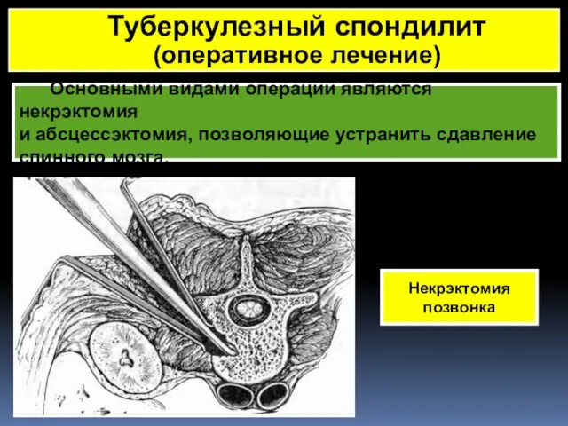 Основными видами операций являются некрэктомия и абсцессэктомия, позволяющие устранить сдавление спинного