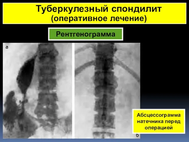 Рентгенограмма Туберкулезный спондилит (оперативное лечение) Абсцессограмма натечника перед операцией