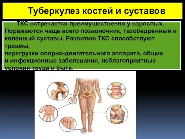 ТКС встречается преимущественно у взрослых. Поражаются чаще всего позвоночник, тазобедренный и