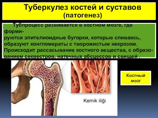 Тубпроцесс развивается в костном мозге, где форми- руются эпителиоидные бугорки, которые