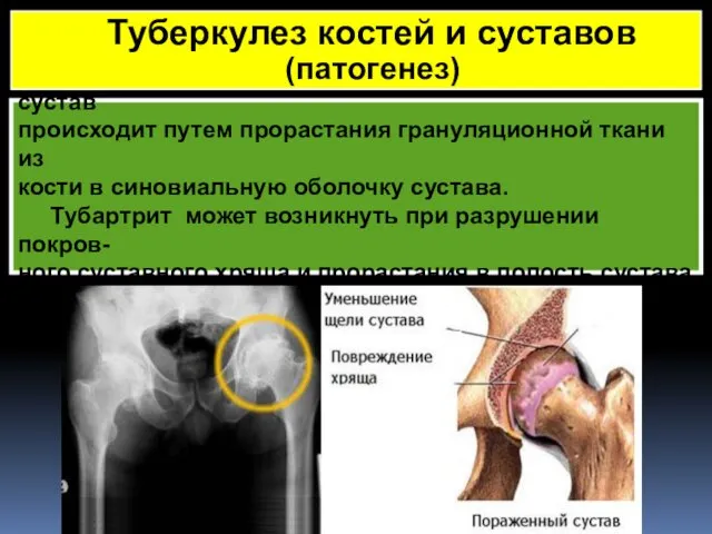 При тубартритах распространение процесса на сустав происходит путем прорастания грануляционной ткани