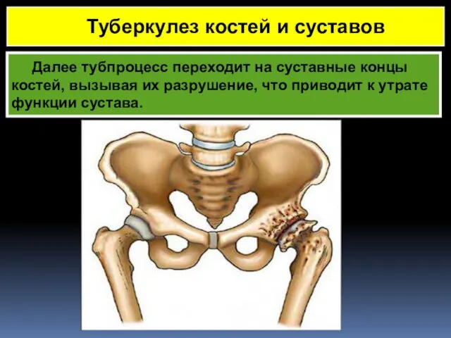 Далее тубпроцесс переходит на суставные концы костей, вызывая их разрушение, что