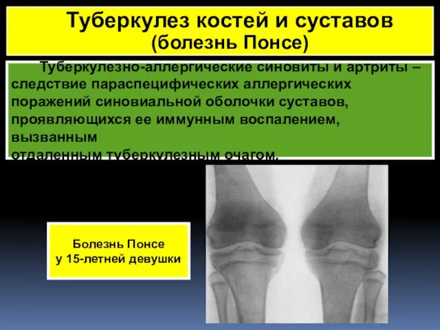 Туберкулезно-аллергические синовиты и артриты – следствие параспецифических аллергических поражений синовиальной оболочки