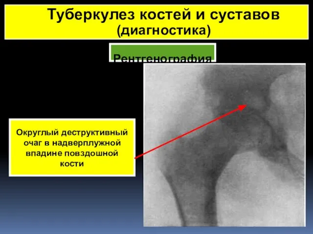 Рентгенография Туберкулез костей и суставов (диагностика) Округлый деструктивный очаг в надверплужной впадине повздошной кости