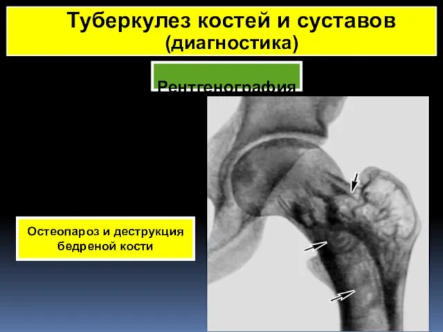 Рентгенография Туберкулез костей и суставов (диагностика) Остеопароз и деструкция бедреной кости