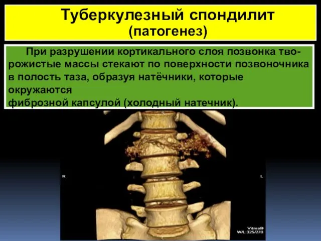 При разрушении кортикального слоя позвонка тво- рожистые массы стекают по поверхности