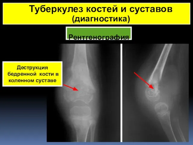 Рентгенография Туберкулез костей и суставов (диагностика) Деструкция бедренной кости в коленном суставе