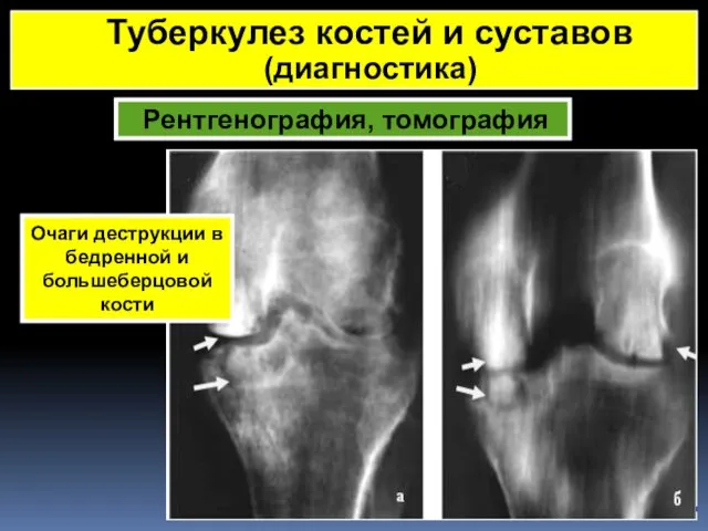 Рентгенография, томография Туберкулез костей и суставов (диагностика) Очаги деструкции в бедренной и большеберцовой кости