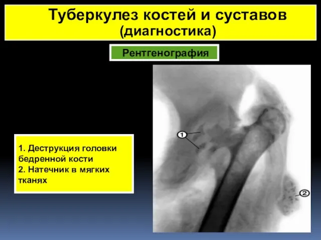 Рентгенография Туберкулез костей и суставов (диагностика) 1. Деструкция головки бедренной кости 2. Натечник в мягких тканях