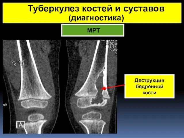 МРТ Туберкулез костей и суставов (диагностика) Деструкция бедренной кости