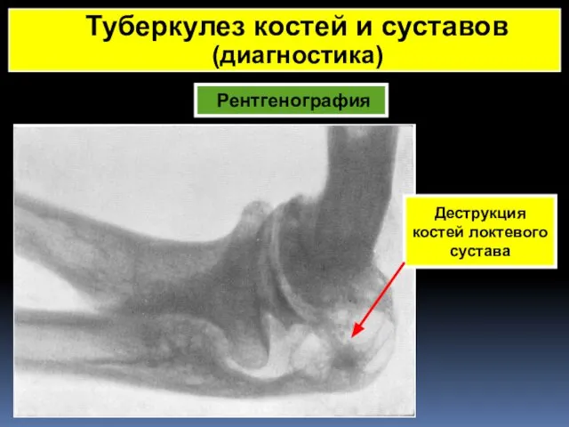 Рентгенография Туберкулез костей и суставов (диагностика) Деструкция костей локтевого сустава