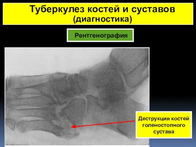 Рентгенография Туберкулез костей и суставов (диагностика) Деструкция костей голеностопного сустава