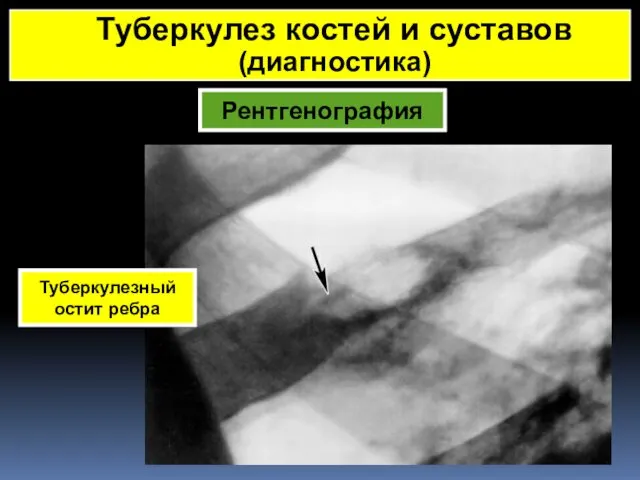 Рентгенография Туберкулез костей и суставов (диагностика) Туберкулезный остит ребра