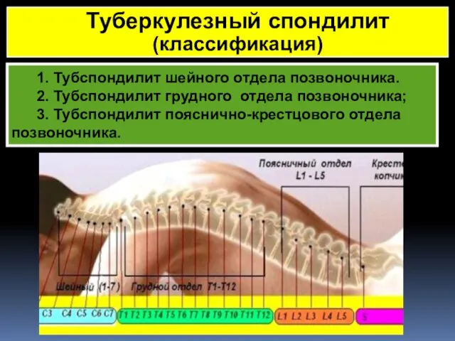 1. Тубспондилит шейного отдела позвоночника. 2. Тубспондилит грудного отдела позвоночника; 3.