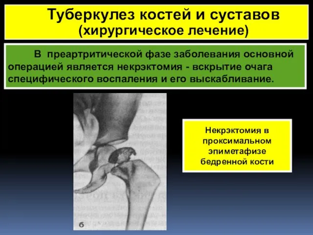 В преартритической фазе заболевания основной операцией является некрэктомия - вскрытие очага