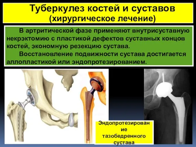 В артритической фазе применяют внутрисуставную некрэктомию с пластикой дефектов суставных концов