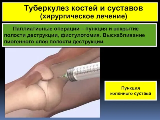 Паллиативные операции – пункция и вскрытие полости деструкции, фистулотомия. Выскабливание пиогенного