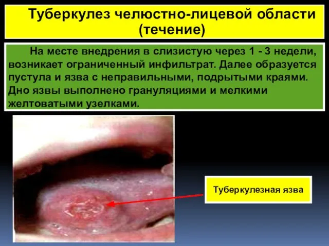 На месте внедрения в слизистую через 1 - 3 недели, возникает