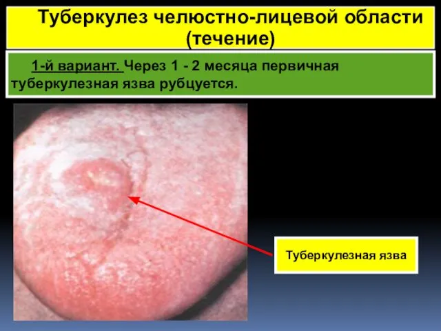 1-й вариант. Через 1 - 2 месяца первичная туберкулезная язва рубцуется.