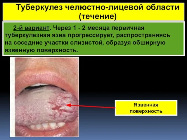 2-й вариант. Через 1 - 2 месяца первичная туберкулезная язва прогрессирует,