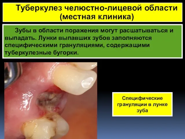 Зубы в области поражения могут расшатываться и выпадать. Лунки выпавших зубов