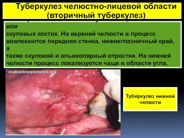 Вторичные очаги локализуются чаще в челюстях или скуловых костях. На верхней