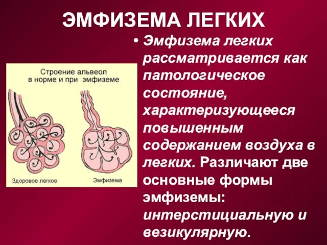 ЭМФИЗЕМА ЛЕГКИХ Эмфизема легких рассматривается как патологическое состоя­ние, характеризующееся повышенным содержанием