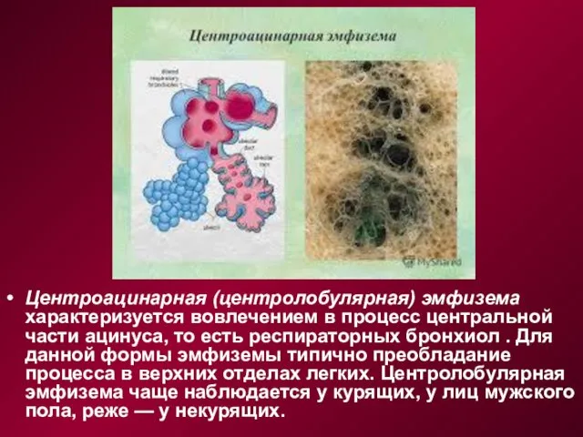 Центроацинарная (центролобулярная) эмфизема характеризу­ется вовлечением в процесс центральной части ацинуса, то