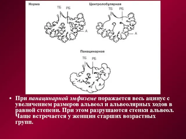 При панацинарной эмфиземе поражается весь ацинус с увеличением размеров альвеол и