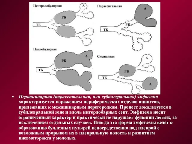 Периацинарная (парасептальная, или субплевральная) эмфи­зема характеризуется поражением периферических отделов ацинусов, прилежащих