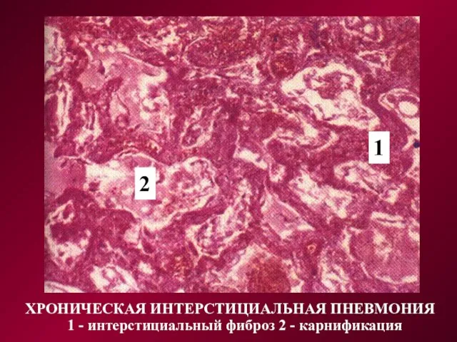 ХРОНИЧЕСКАЯ ИНТЕРСТИЦИАЛЬНАЯ ПНЕВМОНИЯ 1 2 1 - интерстициальный фиброз 2 - карнификация