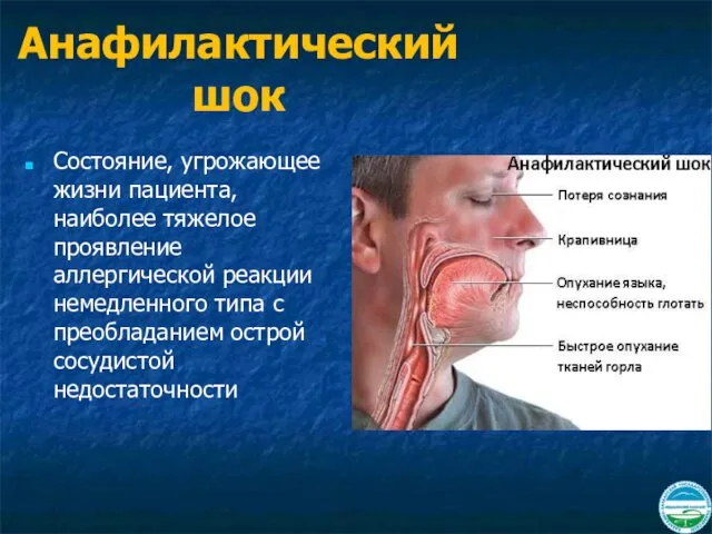 Анафилактический шок Состояние, угрожающее жизни пациента, наиболее тяжелое проявление аллергической реакции