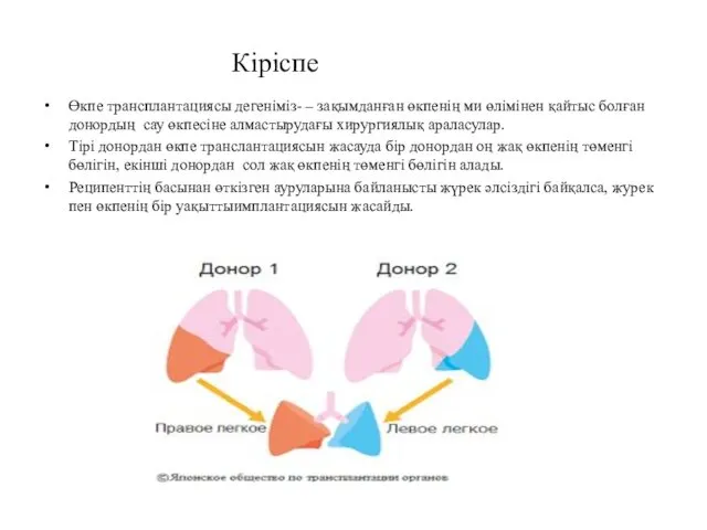 Өкпе трансплантациясы дегеніміз- – зақымданған өкпенің ми өлімінен қайтыс болған донордың