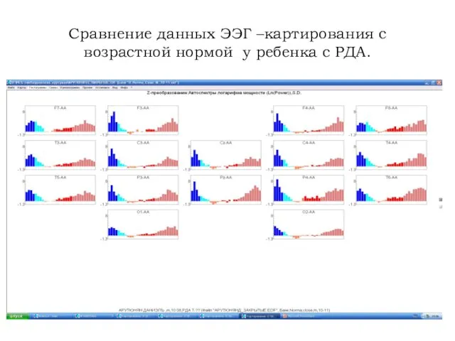 Сравнение данных ЭЭГ –картирования с возрастной нормой у ребенка с РДА.