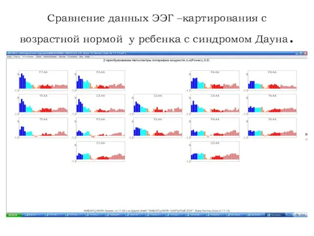 Сравнение данных ЭЭГ –картирования с возрастной нормой у ребенка с синдромом Дауна.