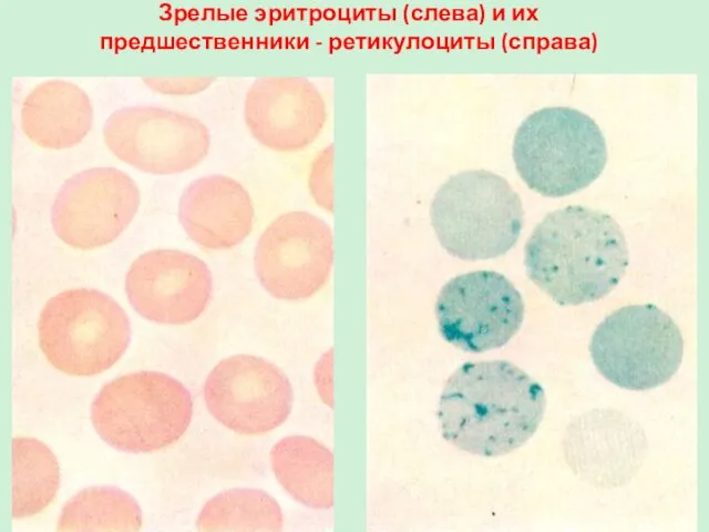 Зрелые эритроциты (слева) и их предшественники - ретикулоциты (справа)