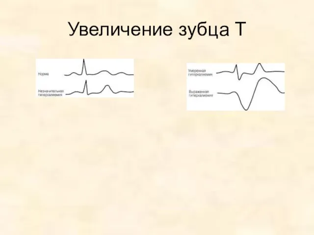 Увеличение зубца Т