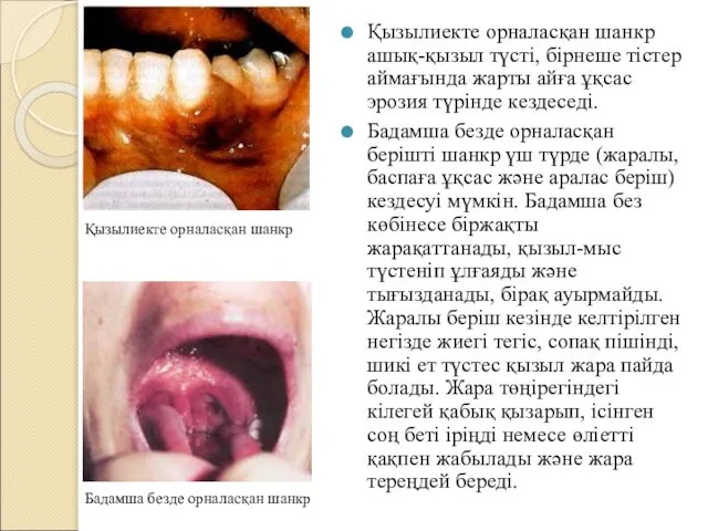 Қызылиекте орналасқан шанкр ашық-қызыл түсті, бірнеше тістер аймағында жарты айға ұқсас