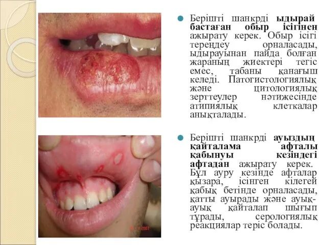 Берішті шанкрді ыдырай бастаған обыр ісігінен ажырату керек. Обыр ісігі тереңдеу