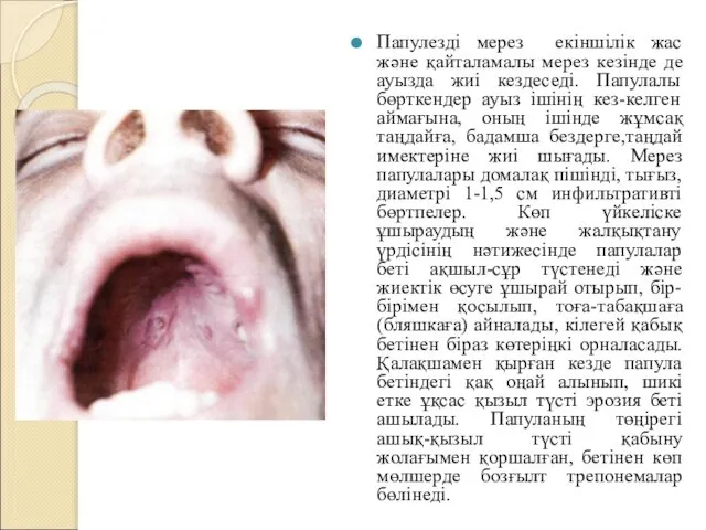 Папулезді мерез екіншілік жас және қайталамалы мерез кезінде де ауызда жиі