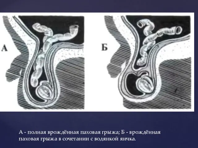 А - полная врождённая паховая грыжа; Б - врождённая паховая грыжа в сочетании с водянкой яичка.