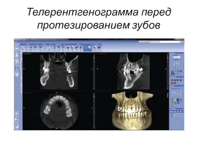 Телерентгенограмма перед протезированием зубов