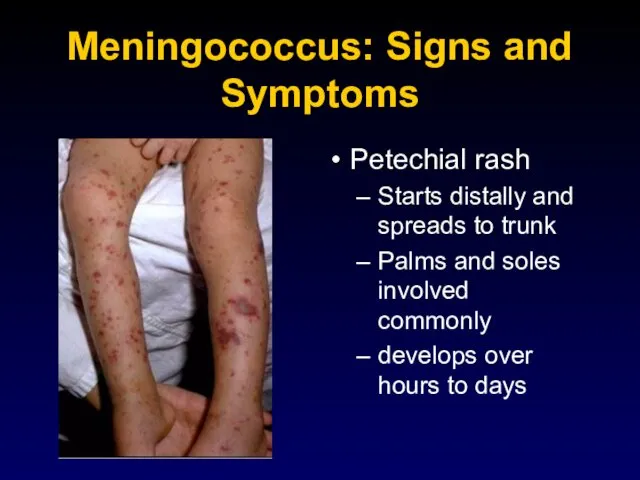 Meningococcus: Signs and Symptoms Petechial rash Starts distally and spreads to