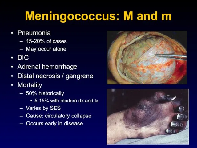 Meningococcus: M and m Pneumonia 15-20% of cases May occur alone