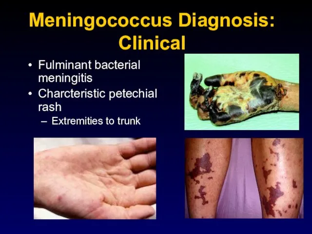 Meningococcus Diagnosis: Clinical Fulminant bacterial meningitis Charcteristic petechial rash Extremities to trunk