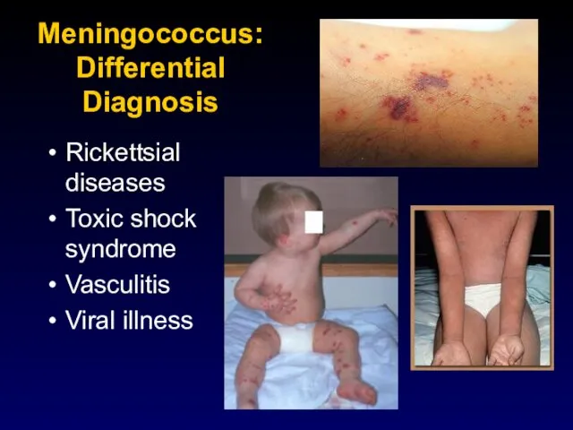 Meningococcus: Differential Diagnosis Rickettsial diseases Toxic shock syndrome Vasculitis Viral illness
