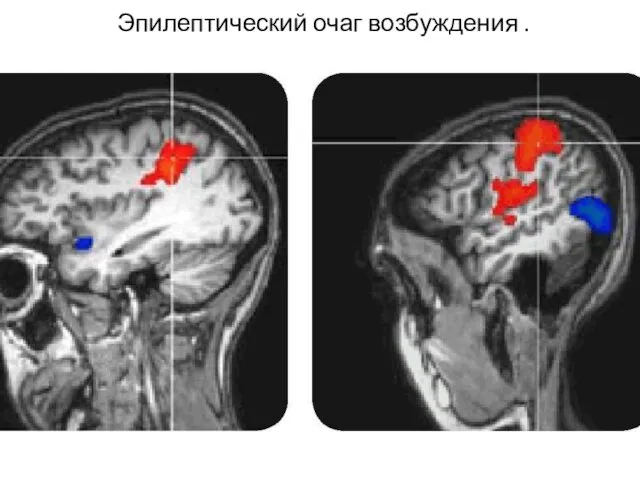 Эпилептический очаг возбуждения .